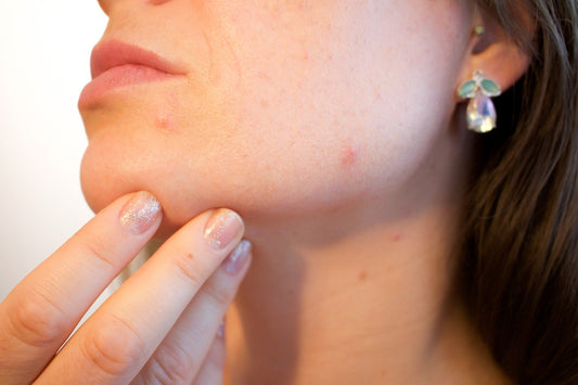 Top 4 Tips to Prevent Maskne